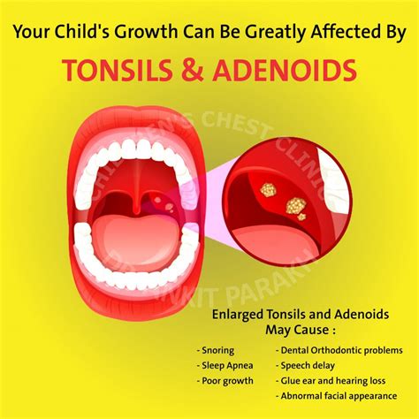 tonsil® 